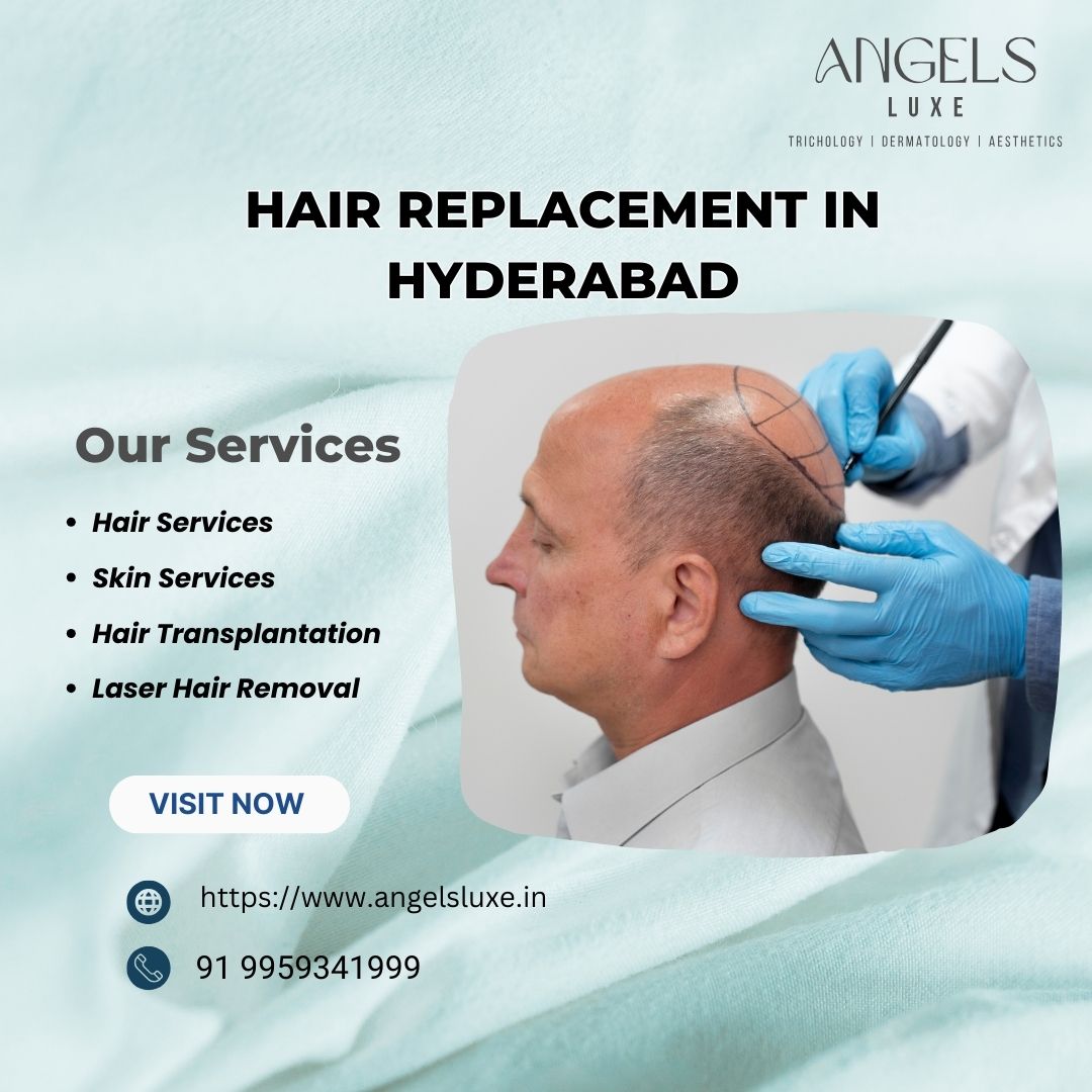 Hair Plantation in Hyderabad | +91 9959341999 | Angels Luxe