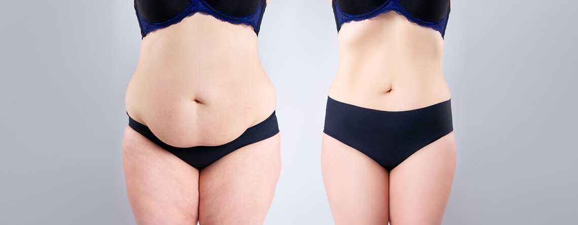 Tummy Tuck Surgery cost in Delhi – Dr Rajat Gupta