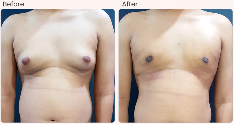 Gynecomastia Surgery Cost in Delhi – Dr Rajat Gupta