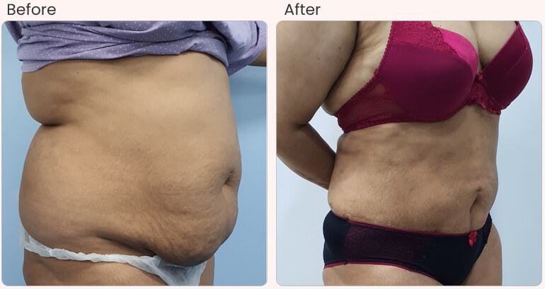 Liposuction Surgery Cost in Delhi – Dr Rajat Gupta