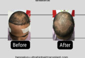 Best affordable hair transplant clinic in Bengaluru