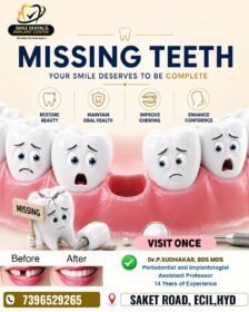 Missing-Teeth