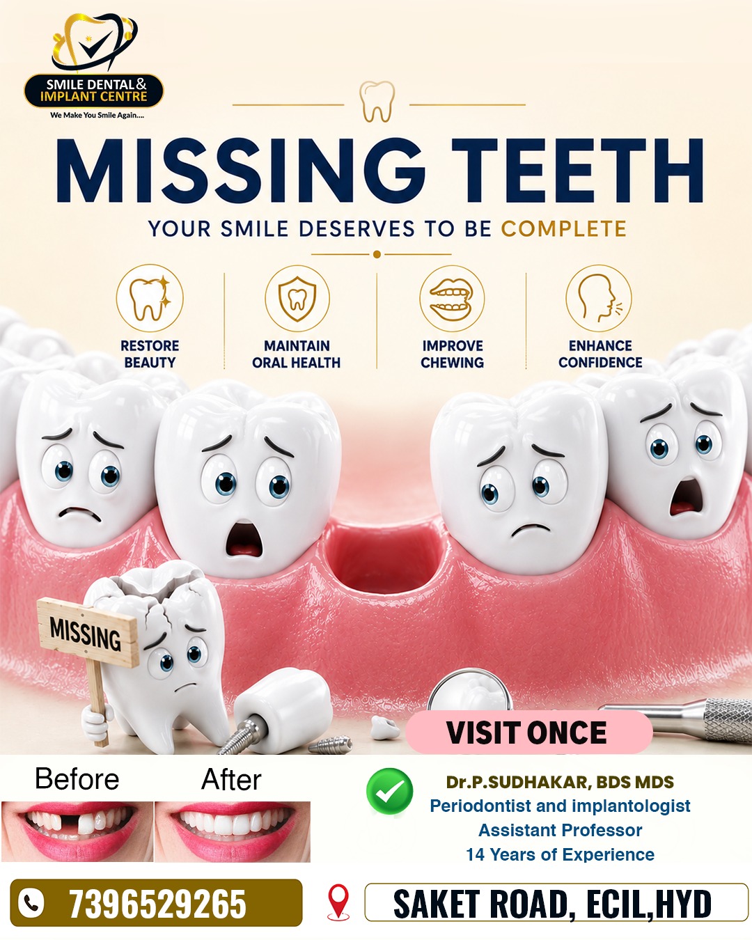 Permanent Solutions for Missing Teeth – Advanced Dental Implants