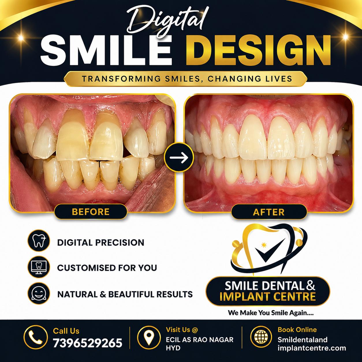 Digital Smile Design in AS Rao Nagar, Hyderabad| Smile Dental & Implant Centre