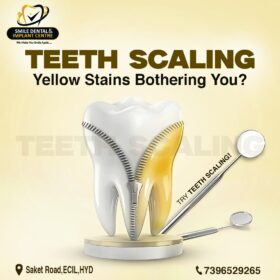 Teeth-Scaling