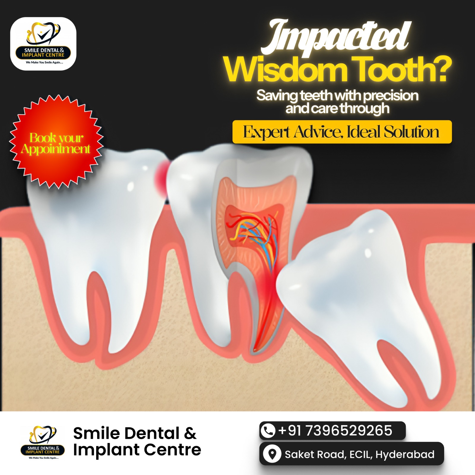 Painless Wisdom Teeth Extraction in Sainikpuri – Expert MDS Surgeons